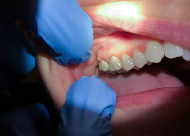 Best Emergency Dentist for Knocked-Out Tooth in Wtmore Village, HI
